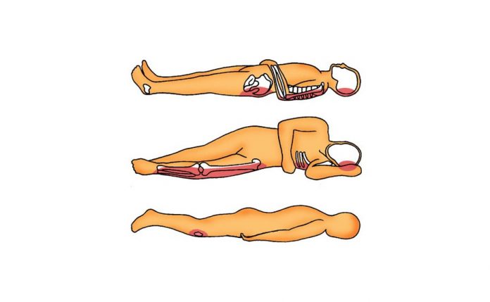 Lesioni Decubito Lesioni Decubito